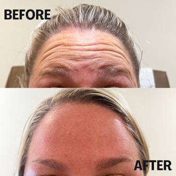 Forehead Lines with Botox Cosmetic