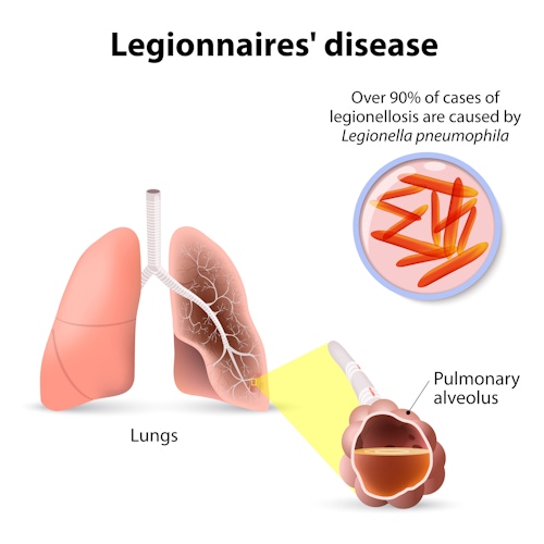 Why Now is the Time to Look at Legionnaires’ Disease